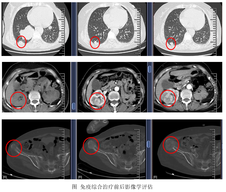 晚期肾透明细胞癌：新抗原肽纳米疫苗为基础的综合免疫治疗达混合疗效