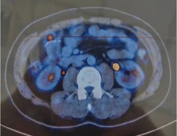 鼓医病例分享:结肠癌术后吻合口旁PET-CT高代谢:肿瘤转移? 鼓医病例分享:结肠癌术后吻合口旁PET-CT高代谢:肿瘤转移?