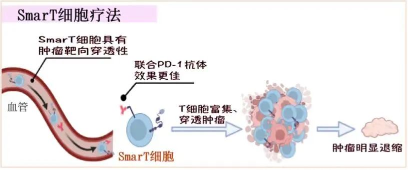 病例分享：晚期胃癌一线采用SmarT细胞联合治疗显著获益